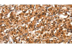 Immunohistochemistry of paraffin-embedded Human thyroid cancer tissue using DDX4 Polyclonal Antibody at dilution 1:40 (DDX4 抗体)