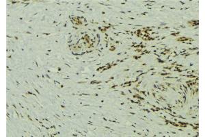 ABIN6273240 at 1/100 staining Human breast cancer tissue by IHC-P. (ETV5 抗体  (Internal Region))