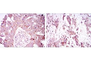 Immunohistochemical analysis of paraffin-embedded ovarian cancer tissues (left) and lung cancer tissues (right) using ATXN1 mouse mAb with DAB staining.