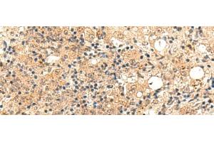 Immunohistochemistry of paraffin-embedded Human esophagus cancer tissue using ZFYVE27 Polyclonal Antibody at dilution of 1:50(x200) (ZFYVE27 抗体)