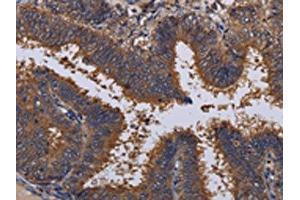 The image on the left is immunohistochemistry of paraffin-embedded Human colon cancer tissue using ABIN7130206(MCTS1 Antibody) at dilution 1/30, on the right is treated with fusion protein. (MCTS1 抗体)
