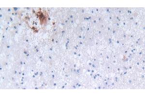 Detection of DEFa3 in Human Glioma Tissue using Polyclonal Antibody to Defensin Alpha 3, Neutrophil Specific (DEFa3) (DEFa3 抗体  (AA 21-94))