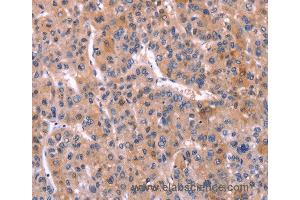 Immunohistochemistry of Human liver cancer using TNFRSF17 Polyclonal Antibody at dilution of 1:30 (BCMA 抗体)