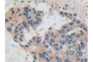 IHC-P analysis of Human Breast cancer Tissue, with DAB staining. (CSN2 抗体  (AA 41-198))