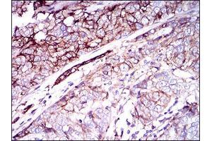Immunohistochemical analysis of paraffin-embedded bladder cancer tissues using CD59 mouse mAb with DAB staining. (CD59 抗体  (AA 31-111))
