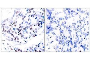 Immunohistochemical analysis of paraffin-embedded human breast carcinoma tissue using c-Jun (Ab-239) antibody (E021024). (C-JUN 抗体)