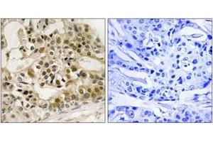 Immunohistochemistry analysis of paraffin-embedded human breast carcinoma, using Myb (Phospho-Ser532) Antibody. (MYB 抗体  (pSer532))