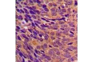 Immunohistochemical analysis of CBR3 staining in human breast cancer formalin fixed paraffin embedded tissue section. (CBR3 抗体)