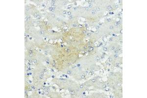 Immunohistochemistry of paraffin-embedded human liver cancer using SOCS5 antibody (ABIN6128734, ABIN6148271, ABIN6148272 and ABIN6223959) at dilution of 1:100 (40x lens). (SOCS5 抗体  (AA 1-140))