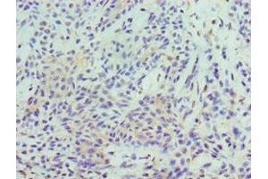 Immunohistochemistry of paraffin-embedded human breast cancer using ABIN7169685 at dilution of 1:100 (STAT5B 抗体  (AA 40-280))