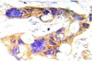 Immunohistochemistry (IHC) analyzes of p-c-RAF antibody in paraffin-embedded human prostate carcinoma tissue. (NCOA1 抗体  (pTyr529))