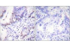 Immunohistochemistry analysis of paraffin-embedded human lung carcinoma, using Abl (Phospho-Tyr412) Antibody. (ABL1 抗体  (pTyr393))