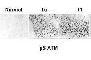 Anti-ATM Monoclonal Antibody - Immunohistochemistry Anti ATM monoclonal Antibody was used to show constitutive activation of the ATM pathway in human urinary bladder cancer. (ATM 抗体  (AA 1974-1988))