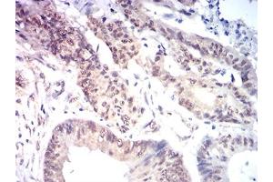 Immunohistochemical analysis of paraffin-embedded colon cancer tissues using KAT7 mouse mAb with DAB staining. (MYST2 抗体  (AA 1-200))
