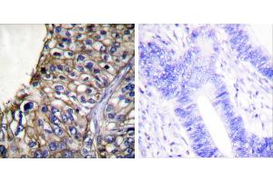 Peptide - +Immunohistochemical analysis of paraffin-embedded human lung carcinoma tissue using Claudin 7 antibody (#C0153). (Claudin 7 抗体)