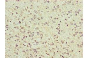 Immunohistochemistry of paraffin-embedded human glioma using ABIN7166519 at dilution of 1:100 (PCDHA12 抗体  (AA 862-941))