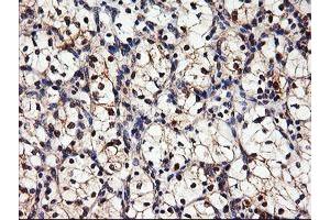 Immunohistochemical staining of paraffin-embedded Carcinoma of Human kidney tissue using anti-DPP9 mouse monoclonal antibody. (DPP9 抗体)