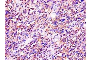 Immunohistochemistry of paraffin-embedded human glioma using ABIN7173542 at dilution of 1:100 (C22orf28 抗体  (AA 52-229))