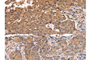 The image on the left is immunohistochemistry of paraffin-embedded Human lung cancer tissue using ABIN7128119(ABCB6 Antibody) at dilution 1/15, on the right is treated with fusion protein. (ABCB6 抗体)