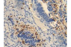 IHC-P analysis of Human Colorectal cancer Tissue, with DAB staining. (OTC 抗体  (AA 78-129))