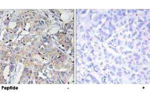 Immunohistochemistry analysis of paraffin-embedded human breast carcinoma tissue using COL6A3 polyclonal antibody . (COL6a3 抗体  (AA 2261-2310))