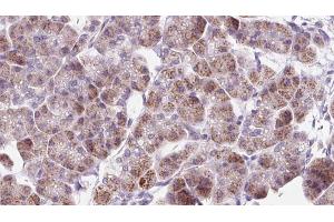 ABIN6273303 at 1/100 staining Human pancreas cancer tissue by IHC-P. (RAB12 抗体  (C-Term))