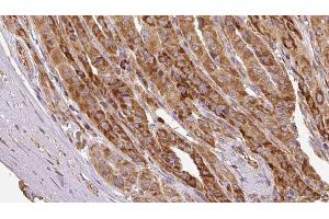 ABIN6267126 at 1/100 staining Human thyroid cancer tissue by IHC-P. (EIF3B 抗体  (pSer154))