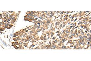 Immunohistochemistry of paraffin-embedded Human esophagus cancer tissue using RCAN3 Polyclonal Antibody at dilution of 1:60(x200) (RCAN3 抗体)