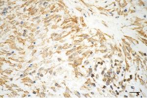 Immunohistochemistry was performed on paraffin-embedded human hepatocarcinoma using aggrecan antibody (ABIN7797541), 1:200).