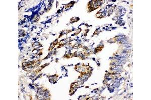 IHC-P: Beta Arrestin 2 antibody testing of human intestinal cancer tissue