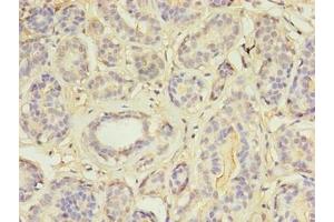 Immunohistochemistry of paraffin-embedded human breast cancer using ABIN7159004 at dilution of 1:100