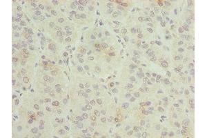 Immunohistochemistry of paraffin-embedded human liver cancer using ABIN7154676 at dilution of 1:100 (GNG5 抗体  (AA 2-65))