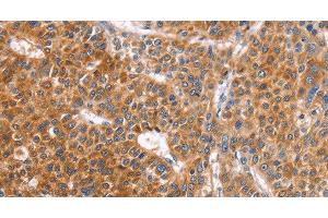 Immunohistochemistry of paraffin-embedded Human liver cancer tissue using ABO Polyclonal Antibody at dilution 1:50 (ABO 抗体)