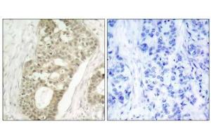 Immunohistochemical analysis of paraffin-embedded human breast carcinoma tissue using PKCδ (phospho- Ser645) antibody (E011296). (PKC delta 抗体  (pSer645))