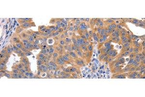 Immunohistochemistry of paraffin-embedded Human ovarian cancer tissue using IRS2 Polyclonal Antibody at dilution 1:100 (IRS2 抗体)
