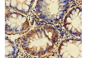 Immunohistochemistry of paraffin-embedded human colon cancer using ABIN7153928 at dilution of 1:100 (GPI 抗体  (AA 2-554))