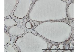 Immunoperoxidase of monoclonal antibody to HNRPM on formalin-fixed paraffin-embedded human thyroid nodular goiter. (HNRNPM 抗体  (AA 17-112))