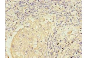 Immunohistochemistry of paraffin-embedded human lung cancer using ABIN7149955 at dilution of 1:100 (FMO2 抗体  (AA 210-470))