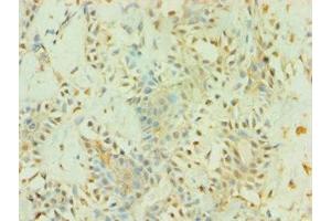 Immunohistochemistry of paraffin-embedded human breast cancer using ABIN7145226 at dilution of 1:100 (BAG5 抗体  (AA 198-447))