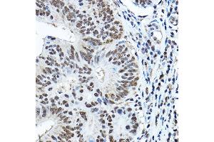 Immunohistochemistry of paraffin-embedded human colon carcinoma using P Rabbit pAb (ABIN3022375, ABIN3022376, ABIN3022377, ABIN1513310 and ABIN6218769) at dilution of 1:150 (40x lens).