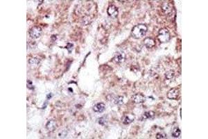 IHC analysis of FFPE human hepatocarcinoma stained with the MARK2 antibody (MARK2 抗体  (AA 600-630))