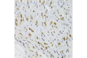 Immunohistochemistry of paraffin-embedded human gastric cancer using DOK1 Antibody (ABIN6130881, ABIN6139763, ABIN6139764 and ABIN6221343) at dilution of 1:100 (40x lens). (DOK1 抗体  (AA 1-280))