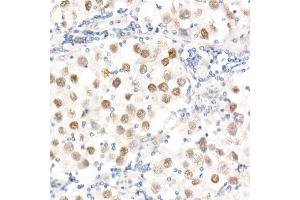 Immunohistochemistry of paraffin-embedded Human testicular seminoma using Nanog Rabbit pAb (ABIN1680964, ABIN3017620, ABIN3017621 and ABIN6220166) at dilution of 1:25 (40x lens). (Nanog 抗体  (AA 1-100))