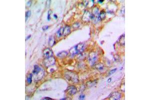 Immunohistochemical analysis of Aggrecan staining in human lung cancer formalin fixed paraffin embedded tissue section. (Aggrecan 抗体  (N-Term))
