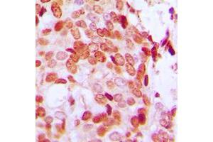 Immunohistochemical analysis of DAXX (pS668) staining in human breast cancer formalin fixed paraffin embedded tissue section. (DAXX 抗体  (C-Term, pSer668))
