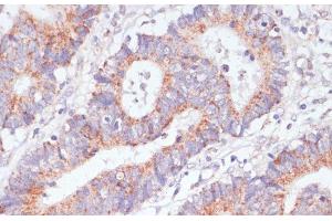 Immunohistochemistry of paraffin-embedded Human colon carcinoma using RAP1A Polyclonal Antibody at dilution of 1:100 (40x lens). (RAP1A 抗体)