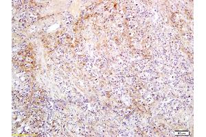 Formalin-fixed and paraffin embedded human colorectal cancer labeled with Anti SLC27A2 Polyclonal Antibody, Unconjugated (ABIN751393) followed by conjugation to the secondary antibody and DAB staining