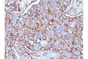 Formalin-fixed, paraffin-embedded human Breast Carcinoma stained with CD44 Mouse Monoclonal Antibody (156-3C11). (CD44 抗体)
