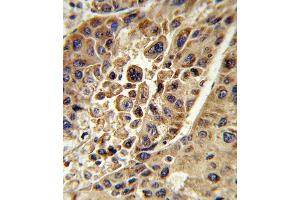 Formalin-fixed and paraffin-embedded human hepatocarcinoma reacted with KMO Antibody (Center), which was peroxidase-conjugated to the secondary antibody, followed by DAB staining. (KMO 抗体  (AA 155-182))