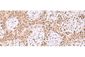Immunohistochemistry of paraffin-embedded Human ovarian cancer tissue using IRX1 Polyclonal Antibody at dilution of 1:35(x200) (IRX1 抗体)
